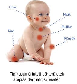 Az allergiás megbetegedések kapcsolata az újszülöttkori bélflóra állapotával